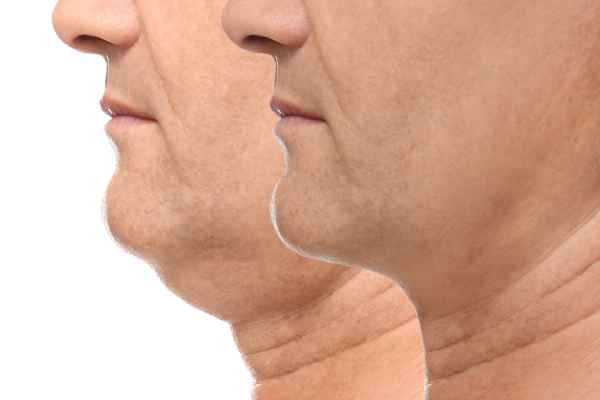 HIFU - Breakthrough in Anti - ageing 2 hifu results Solihull