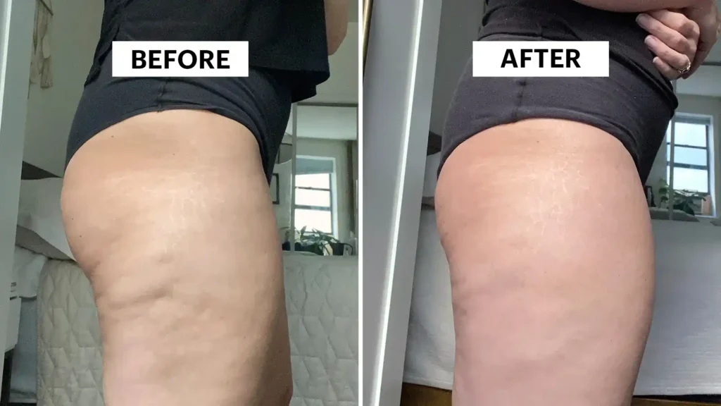 Sculpting Your Bum: Can Toning Exercises Really Reduce Cellulite? 1 Do Toning Exercise Solihull Really Tackle Cellulite?