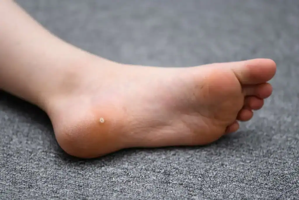 Cryotherapy For Warts And Also Verrucas 2 Image of verruca on the bottom of the foot that able to be treated with Cryotherapy Solihull