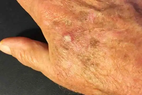 Cryopen For Actinic Keratoses 1 Image of Actinic keratoses Solihull on a person hand
