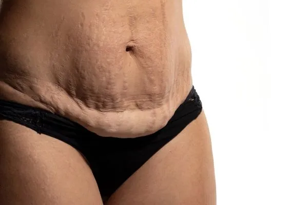 The science behind skin tightening Solihull picture of a woman's sagging skin on the stomach